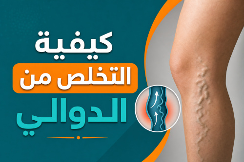 كيفية التخلص من الدوالي